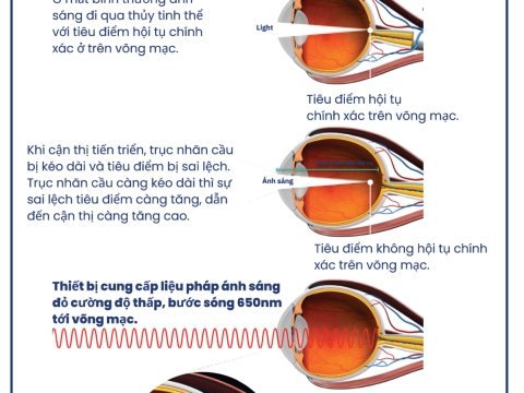  KIỂM SOÁT CẬN THỊ: CHIẾU ÁNH SÁNG ĐỎ